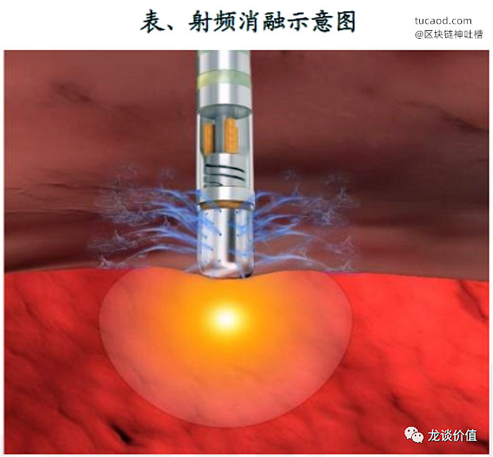 电生理射频消融手术